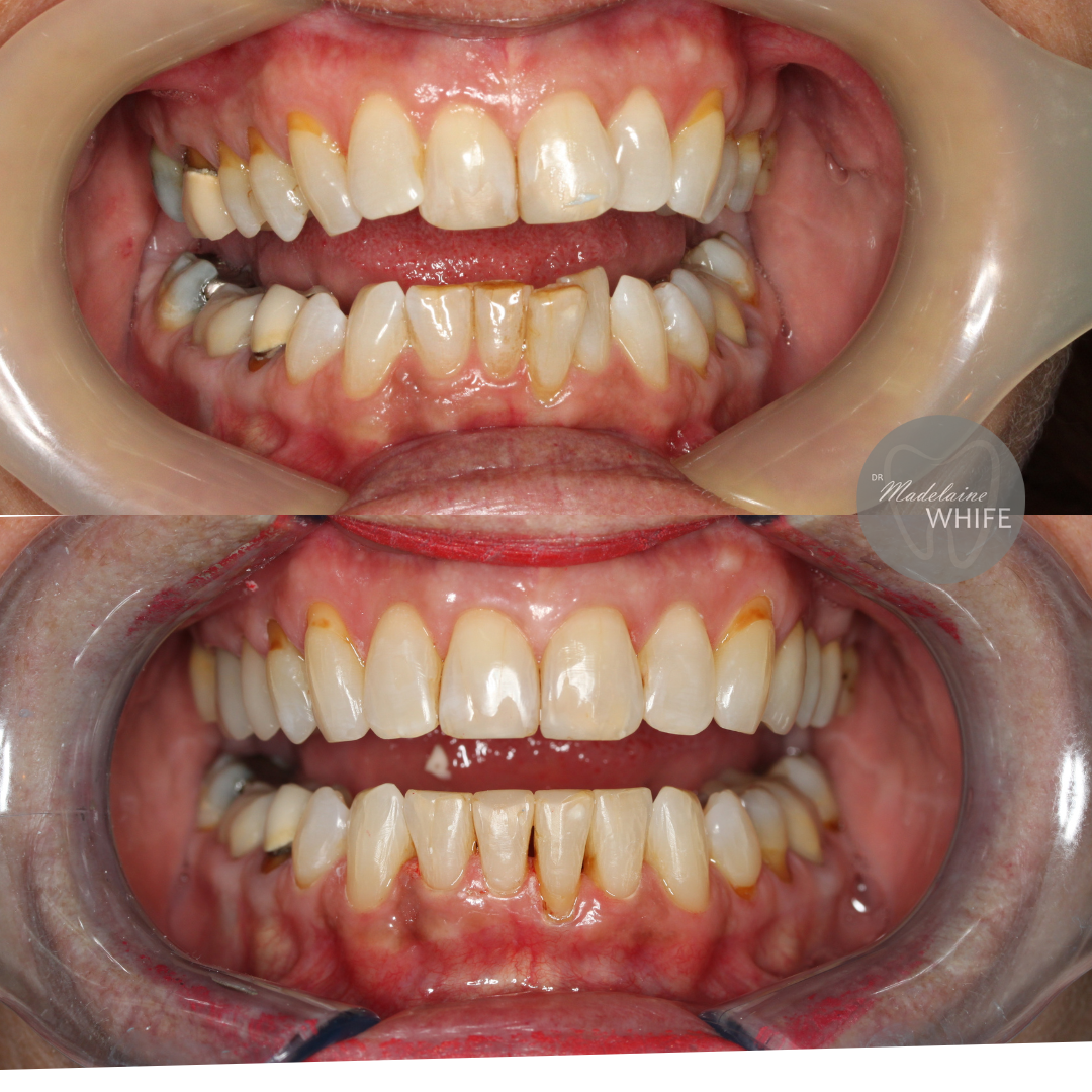 Patient 6 transformation